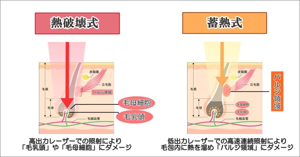 レーザー種類