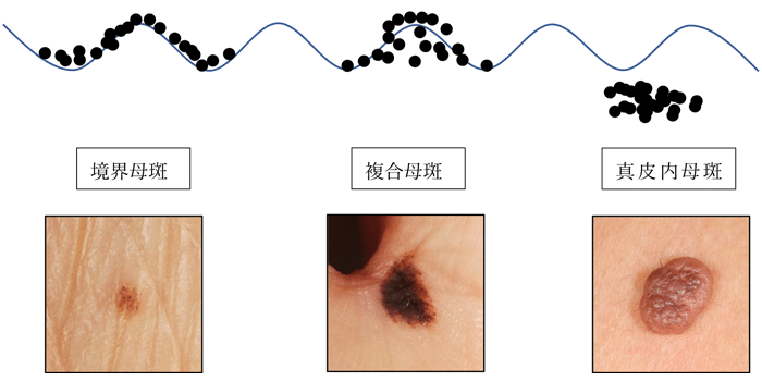 ほくろ 種類