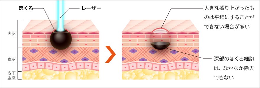 レーザー治療