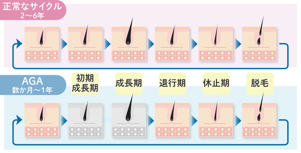 AGA治療の効果実感は約6ヶ月後