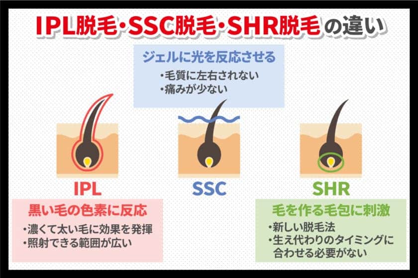 IPL脱毛とSSC脱毛の違い