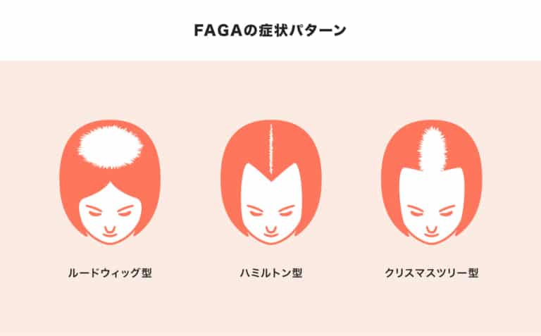 FAGAの症状パターン