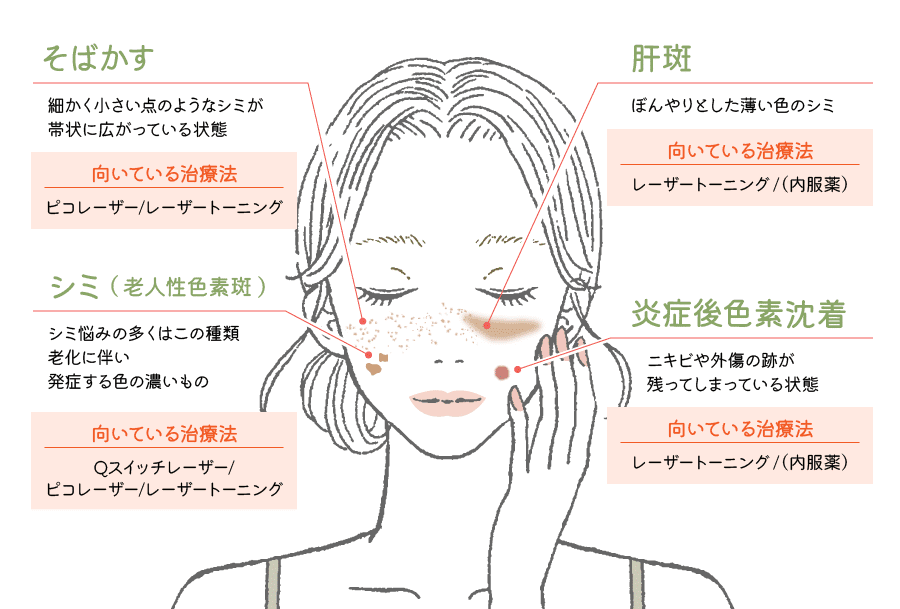 シミの種類とおすすめのシミ取りレーザーについて解説