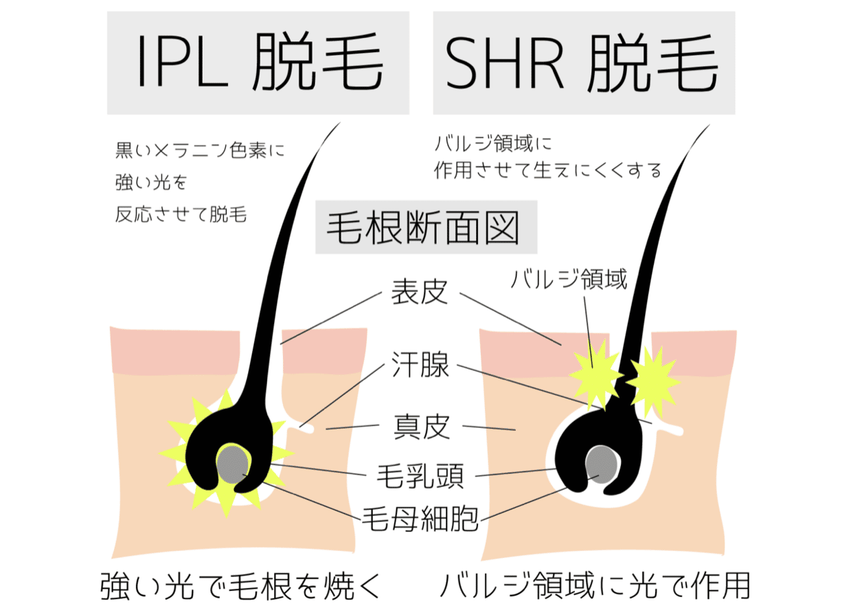 IPL脱毛とSHR脱毛との違い