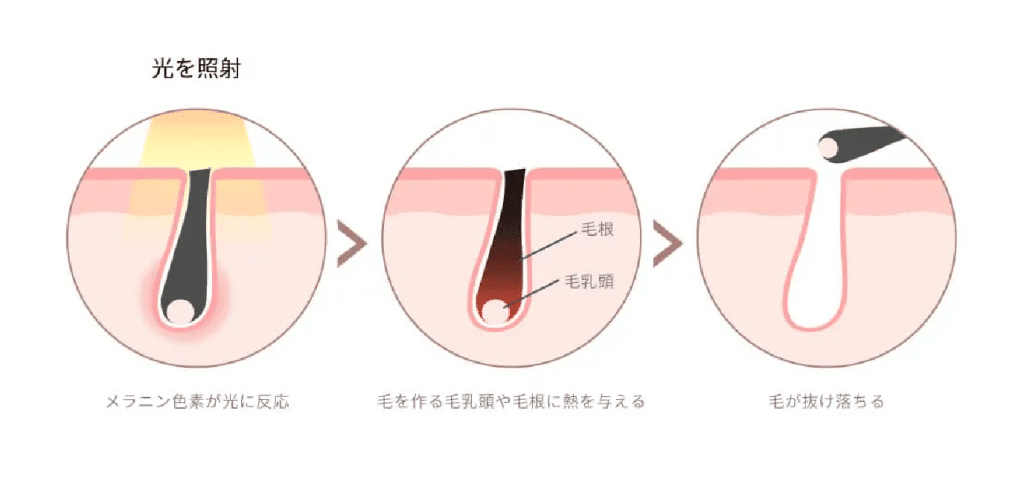 家庭用IPL脱毛器は効果ある？