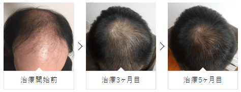 AGAヘアクリニックの症例写真