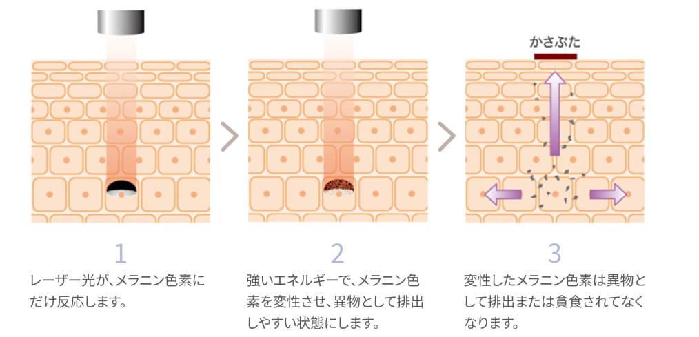 Qスイッチレーザー