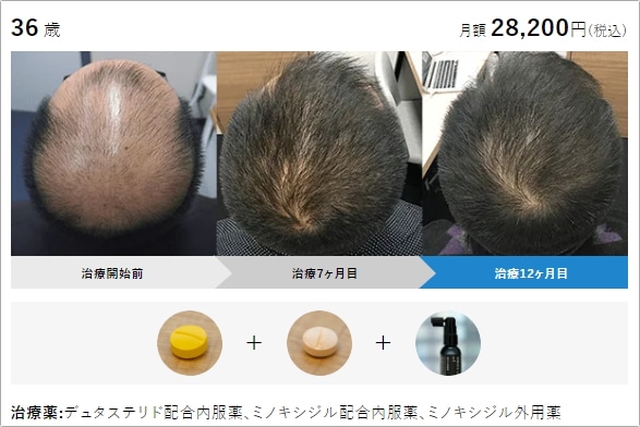 AGAヘアクリニックの症例写真