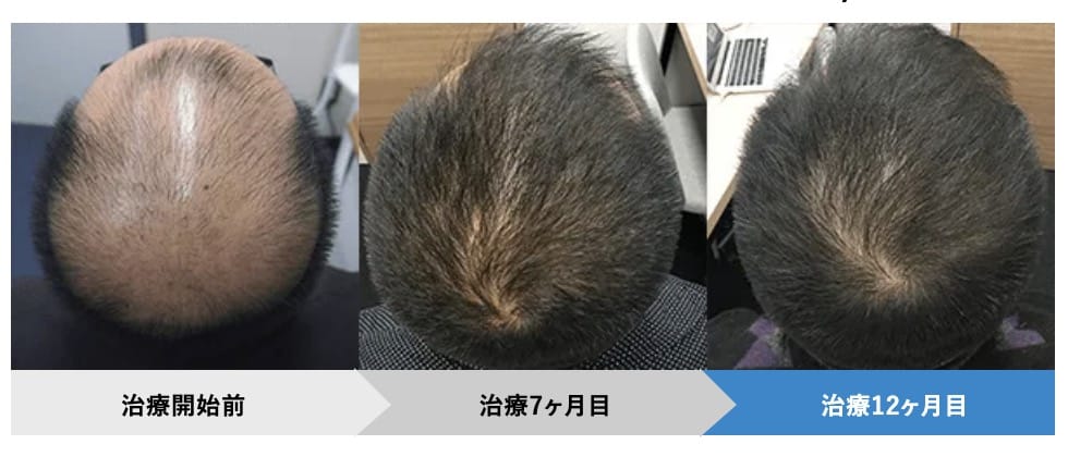 AGAヘアクリニック症例写真