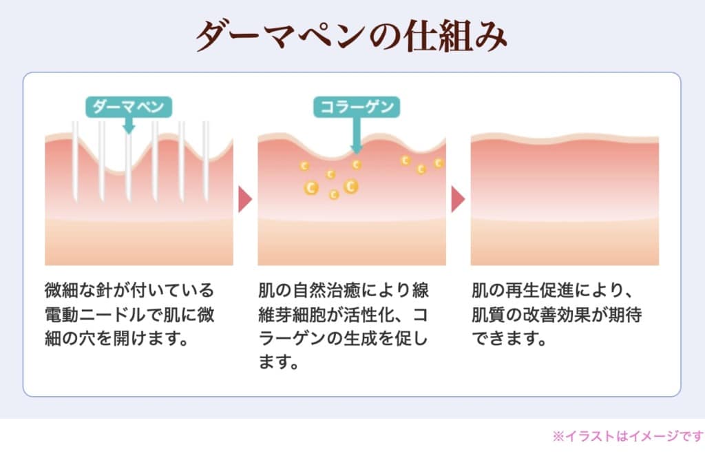 ダーマペンの仕組み