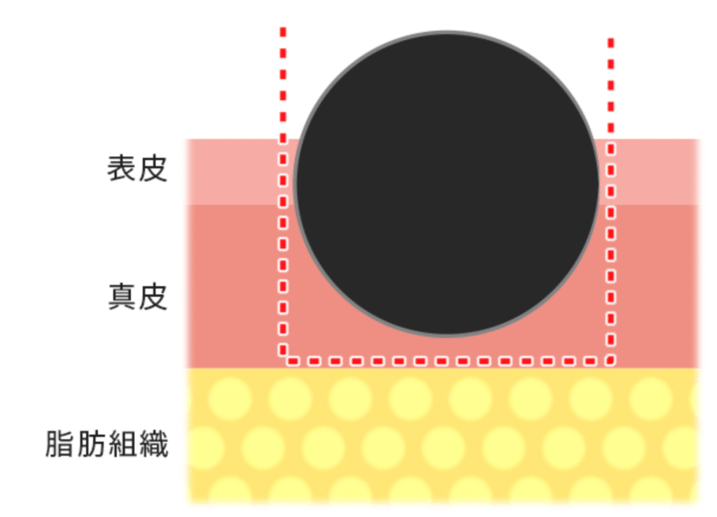 くりぬき法