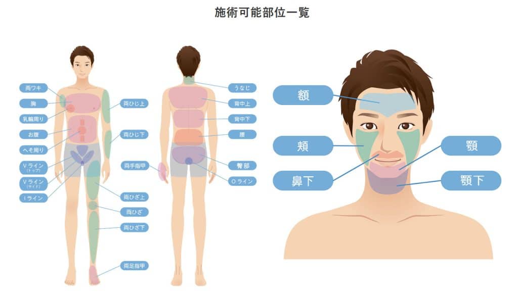 医療脱毛で施術可能な部位