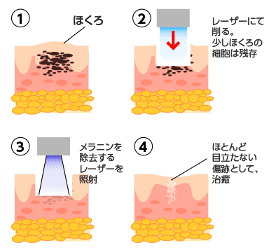 レーザー治療