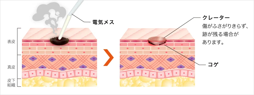 電気分解法の紹介画像