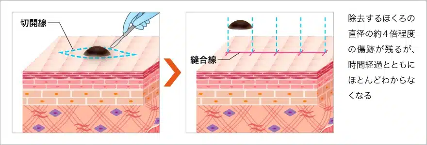 切開