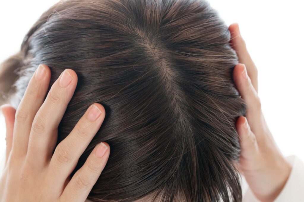 女性に多い薄毛の原因、びまん性脱毛症とは？