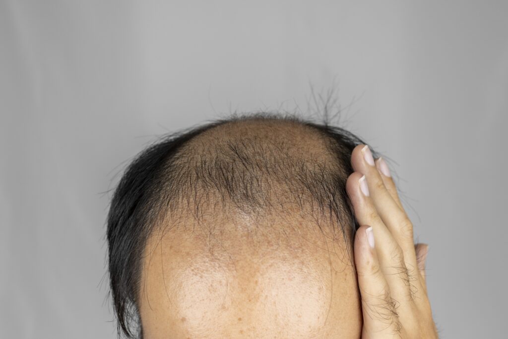 ミノキシジル注射とはカクテル成分を頭皮に直接注入する治療法